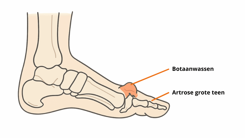 Foto hallux rigidus